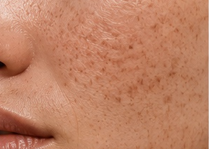 Pigmentation correction treatment