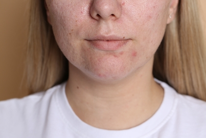 Acne