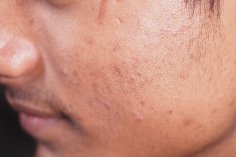 Acne Scarring 1 Acne Scarring