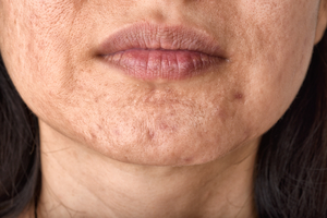 Acne Scarring 2 Acne Scarring