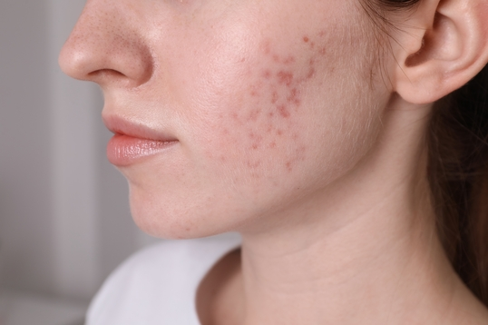 Acne Scarring