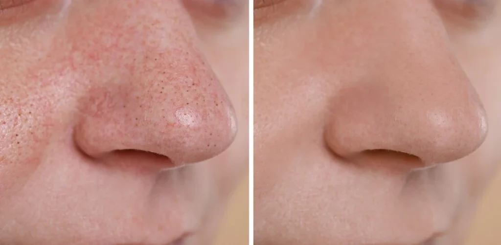 Blackheads