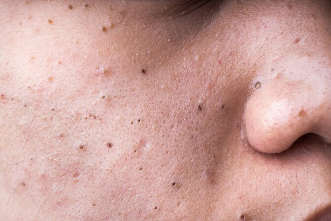 Blackheads 1 Blackheads