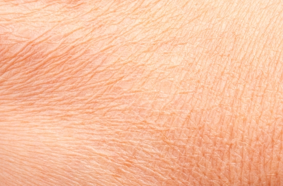 Dehydrated Skin 1 Dehydrated Skin