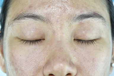Dehydrated Skin 2 Dehydrated Skin