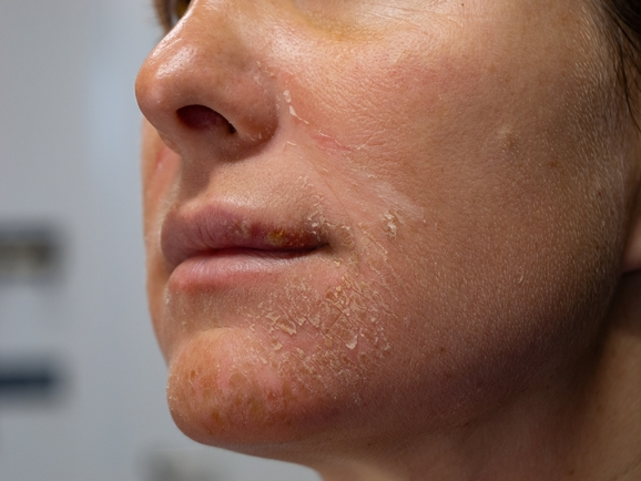 Dehydrated Skin