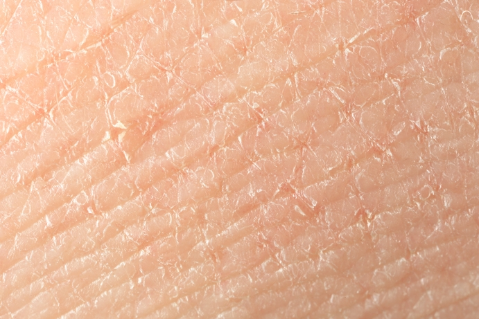 Dry Skin 1 Dry Skin