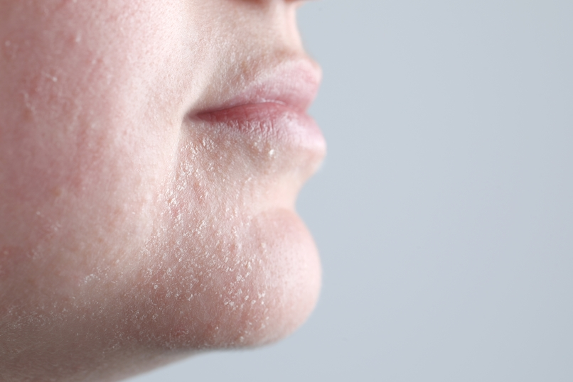 Dry Skin 2 Dry Skin