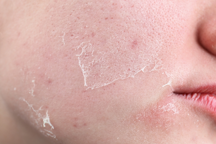 Dry Skin