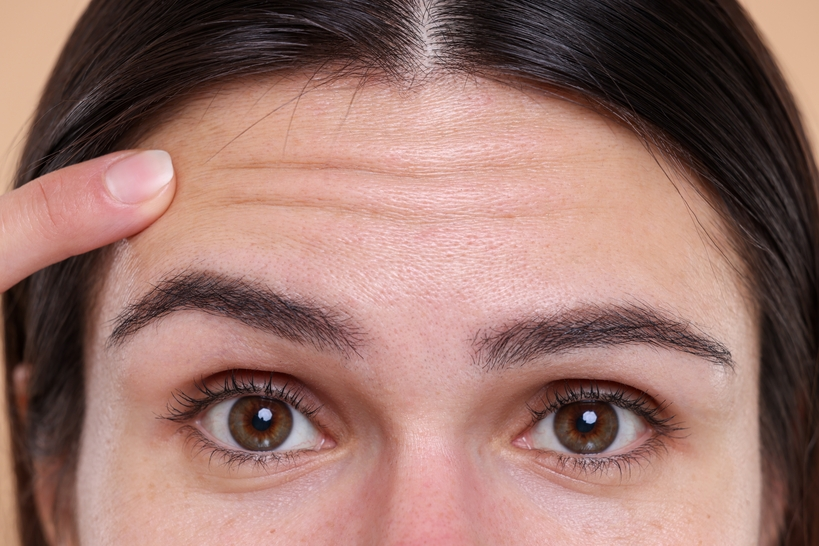 Forehead Lines