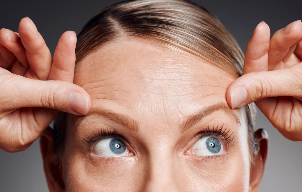 Forehead Lines