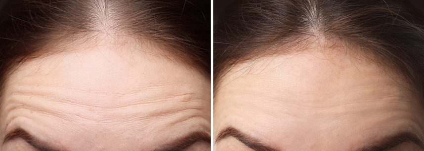 Forehead Lines