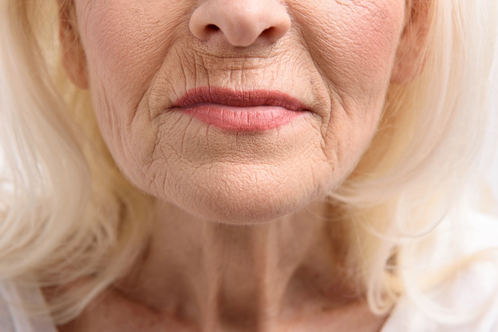 Lip Lines & Thinning Lips 2 Lip Lines & Thinning Lips