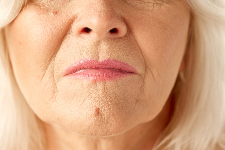 Lip Lines & Thinning Lips 1 Lip Lines & Thinning Lips