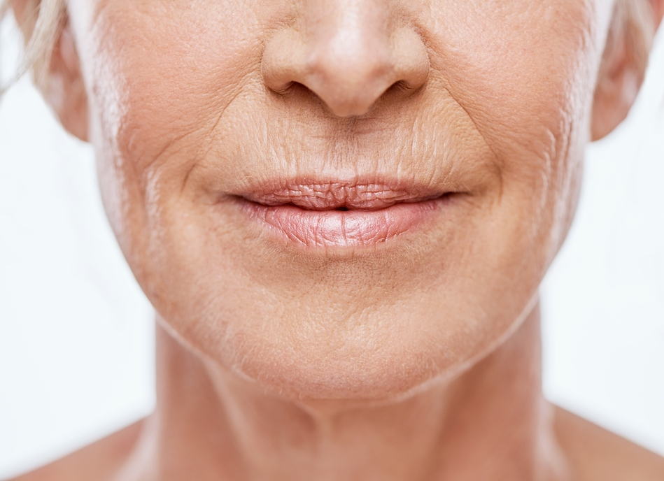 Lip Lines & Thinning Lips