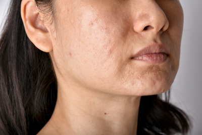 Oily Skin 1 Oily Skin