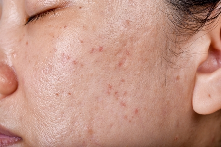 Oily Skin 2 Oily Skin