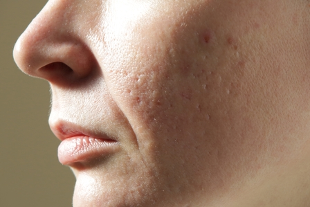 Open Pores 1 Open Pores