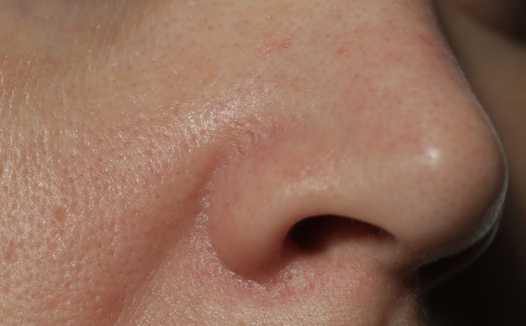 Open Pores
