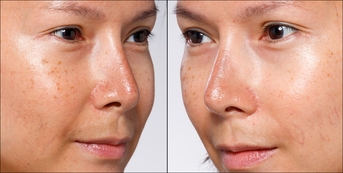 Pigmentation