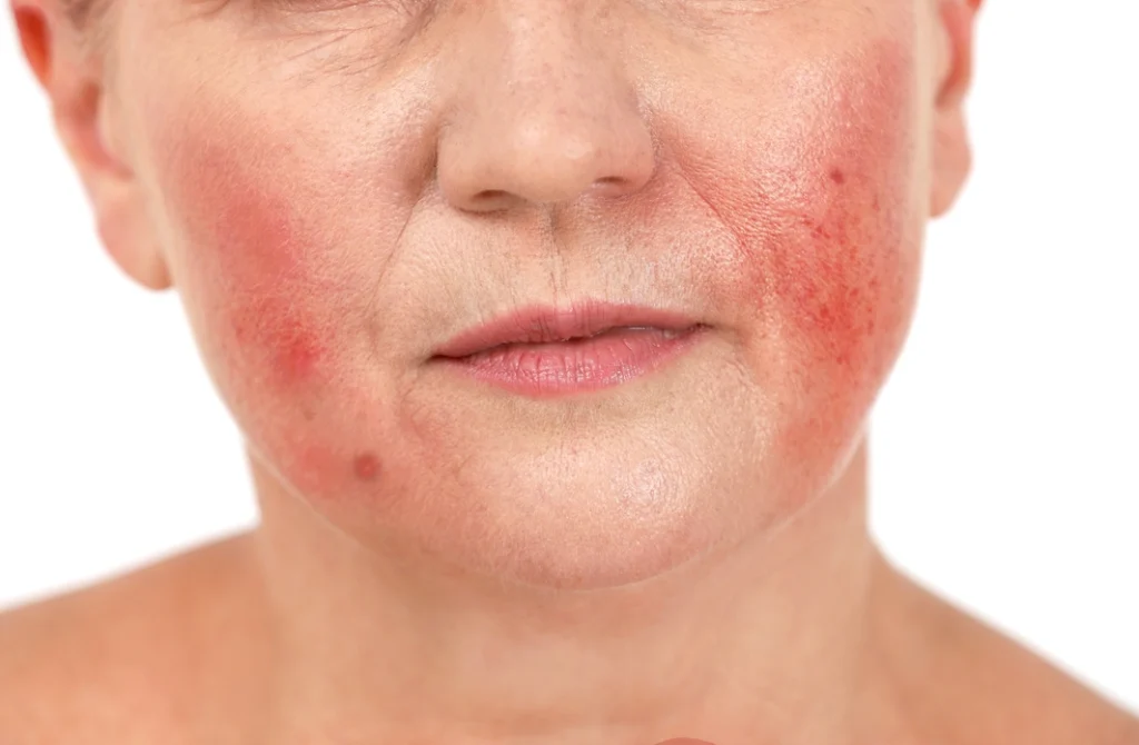 Rosacea 1 Rosacea