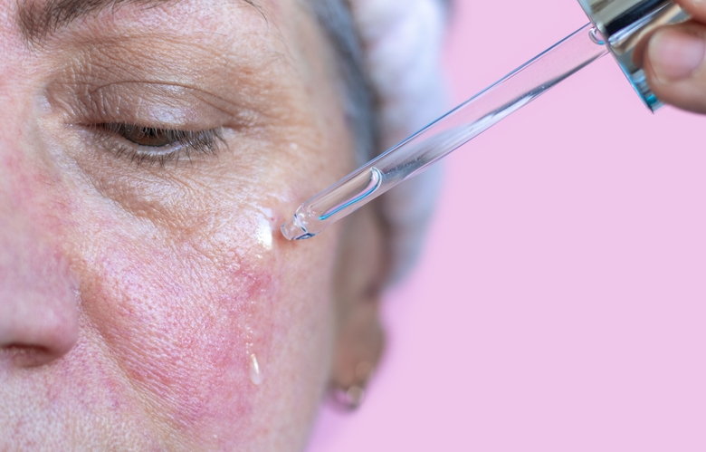 Rosacea 2 Rosacea