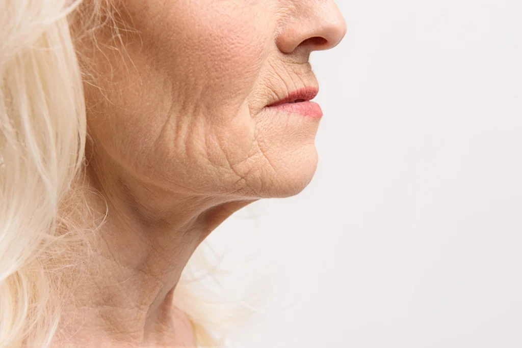 Wrinkles 1 Wrinkles
