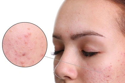 Blemish Control Peel 2 Blemish Control Peel 1