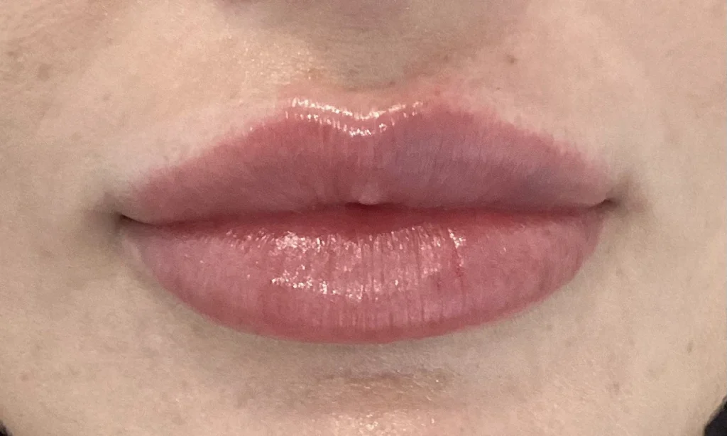 Lip Enhancement