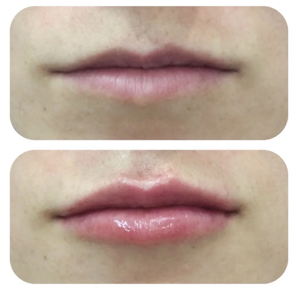 Lip Enhancement 2 Lip enhancement 2