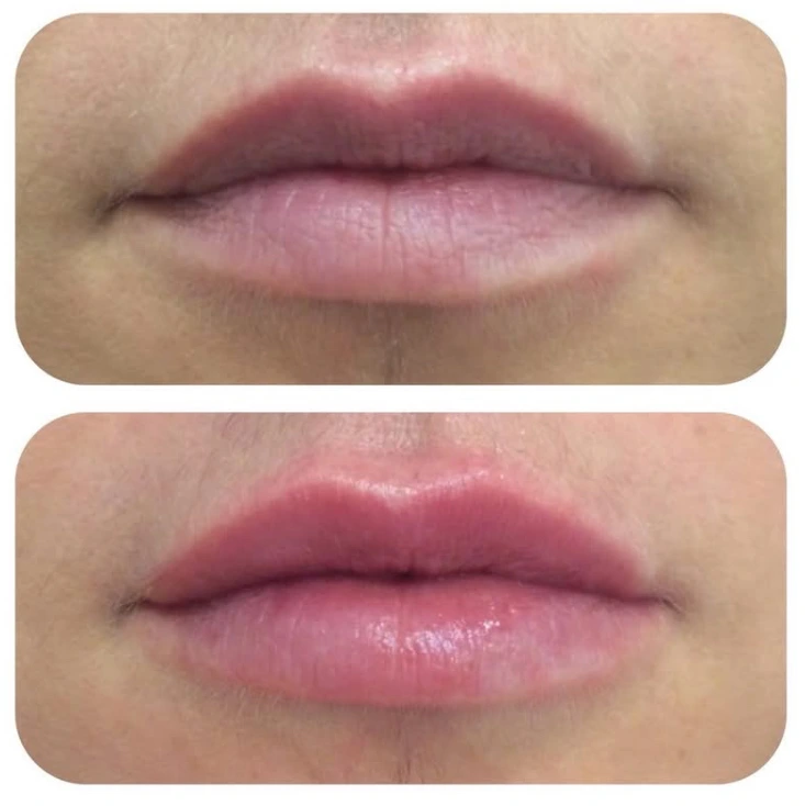 Lip Enhancement 1 Lip enhancement 3