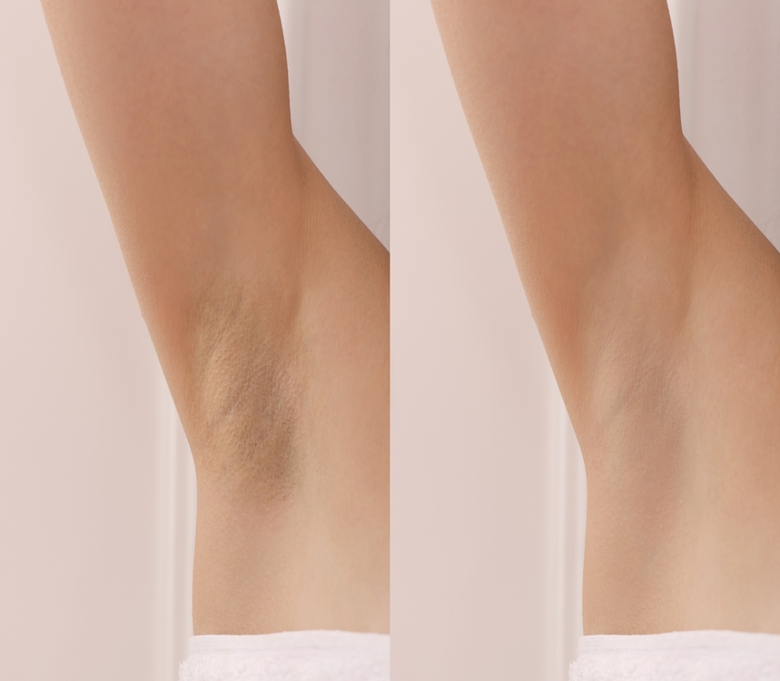 Underarm Wax 1 Underarm Wax