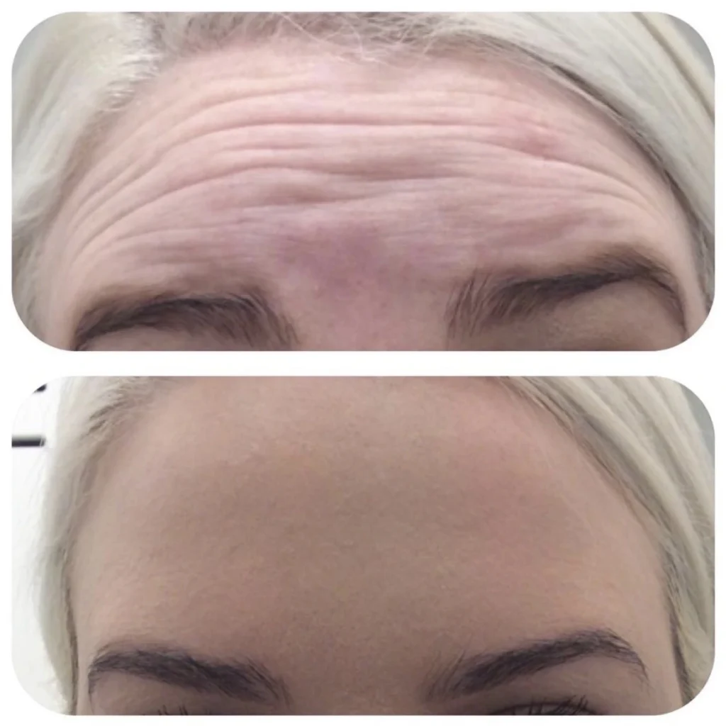 Wrinkle Treatments 2 wrinkles