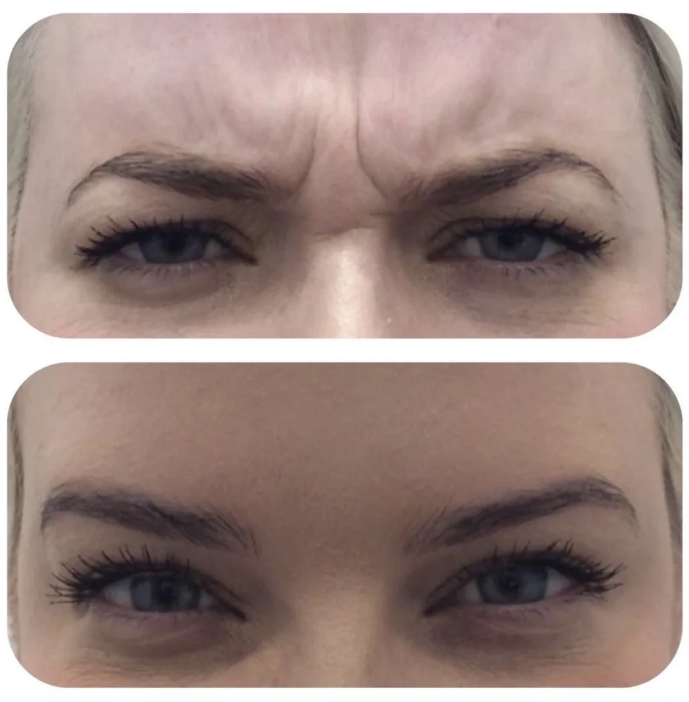 Wrinkle Treatments 1 wrinkles 2